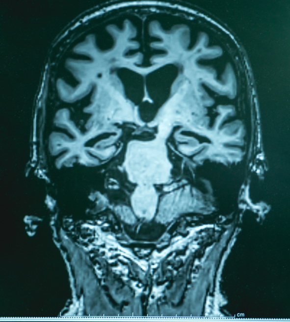 Malattia di Alzheimer, possibile collegamento con cattiva qualità del sonno. Lo studio